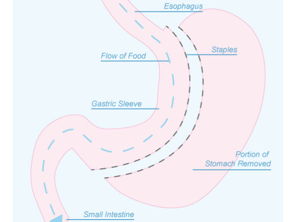 a simple diagram of the stomach depicting what changes would be made by the surgical procedure called gastric sleeve